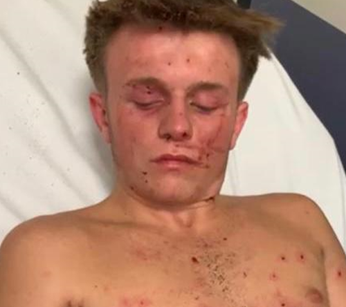 Rio Diveney, from Oldham with injuries on his face and body lying in a hospital bed, after a firework exploded in his hands